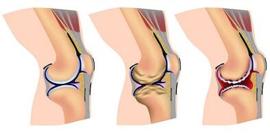 Etapas de desarrollo de la arteria de la articulación de la rodilla